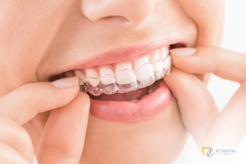 Invisalign Perth - JC Dental Como