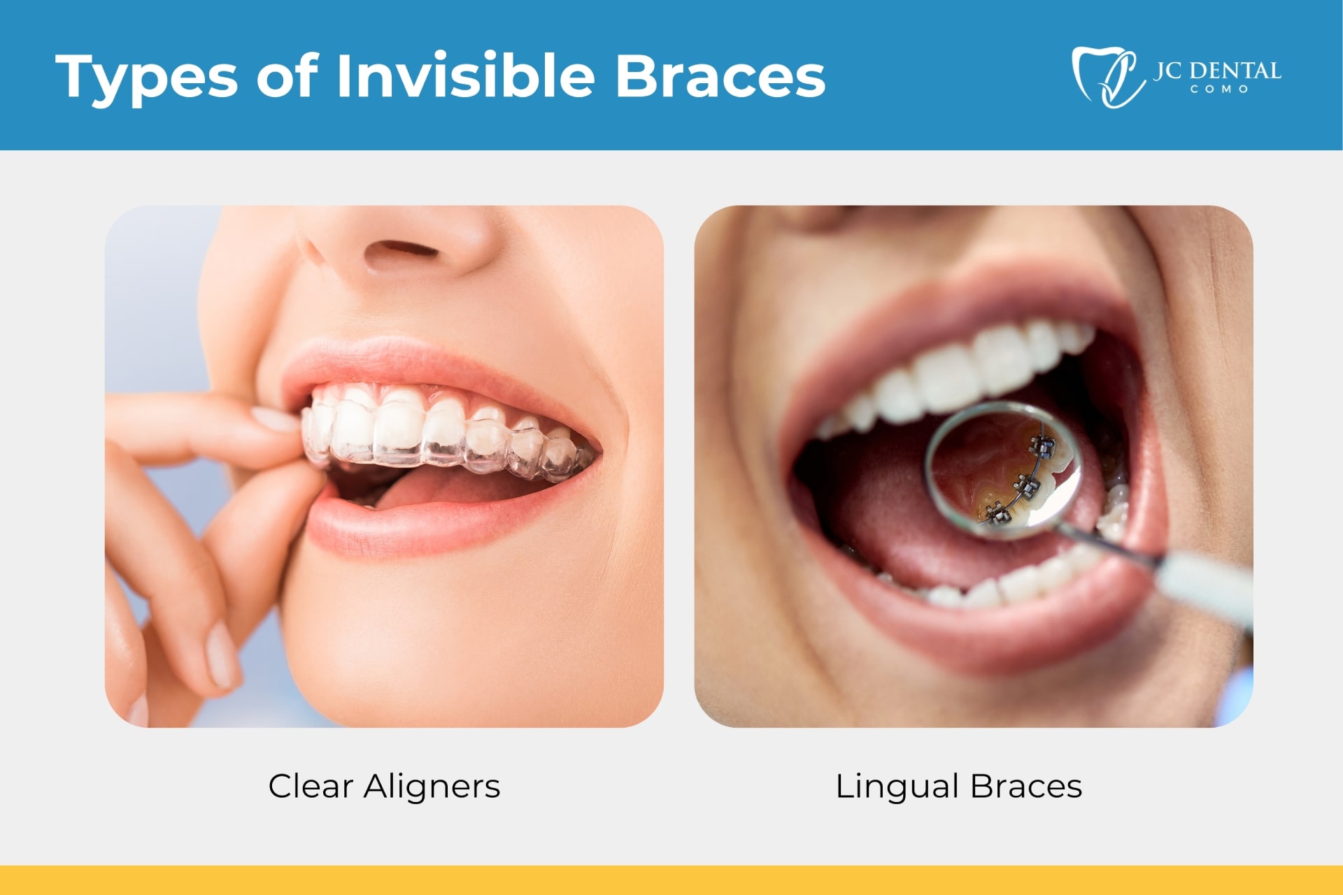 types of invisible braces