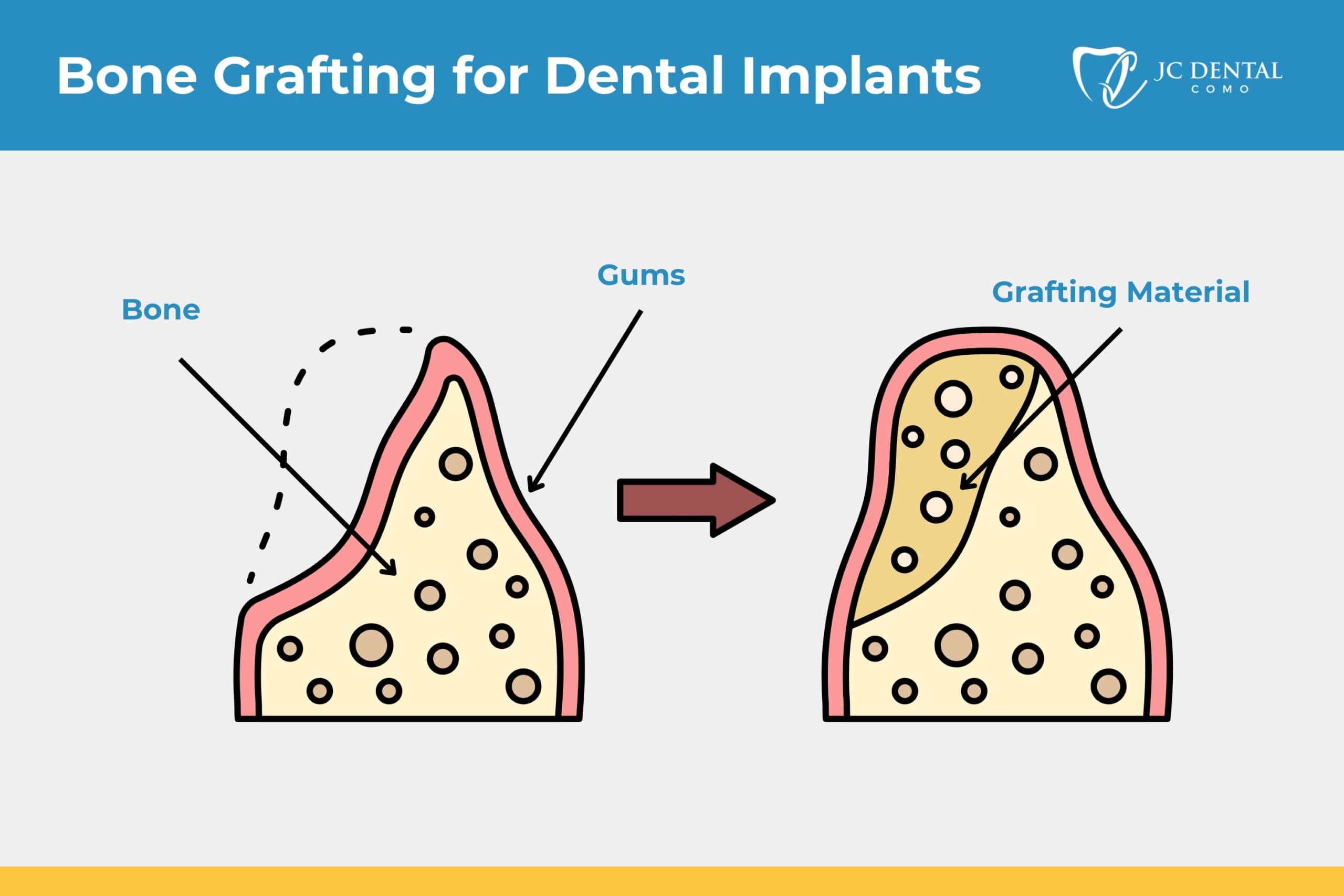 Bone Grafting and Dental Implants