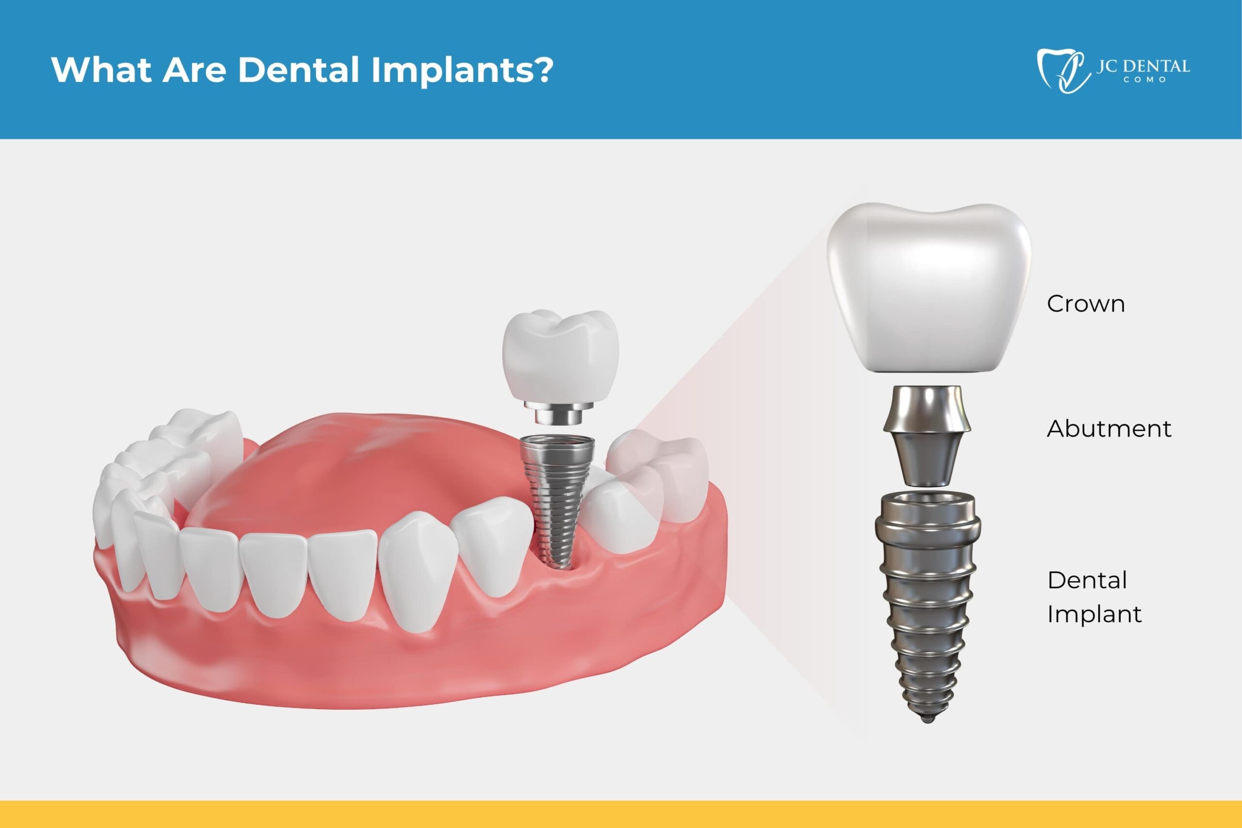 Dental Implants