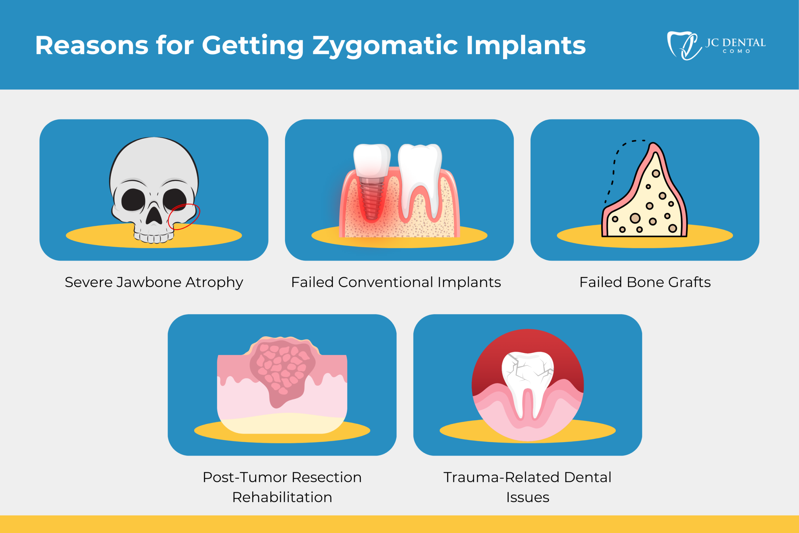 Reasons for Getting Zygomatic Dental Implants