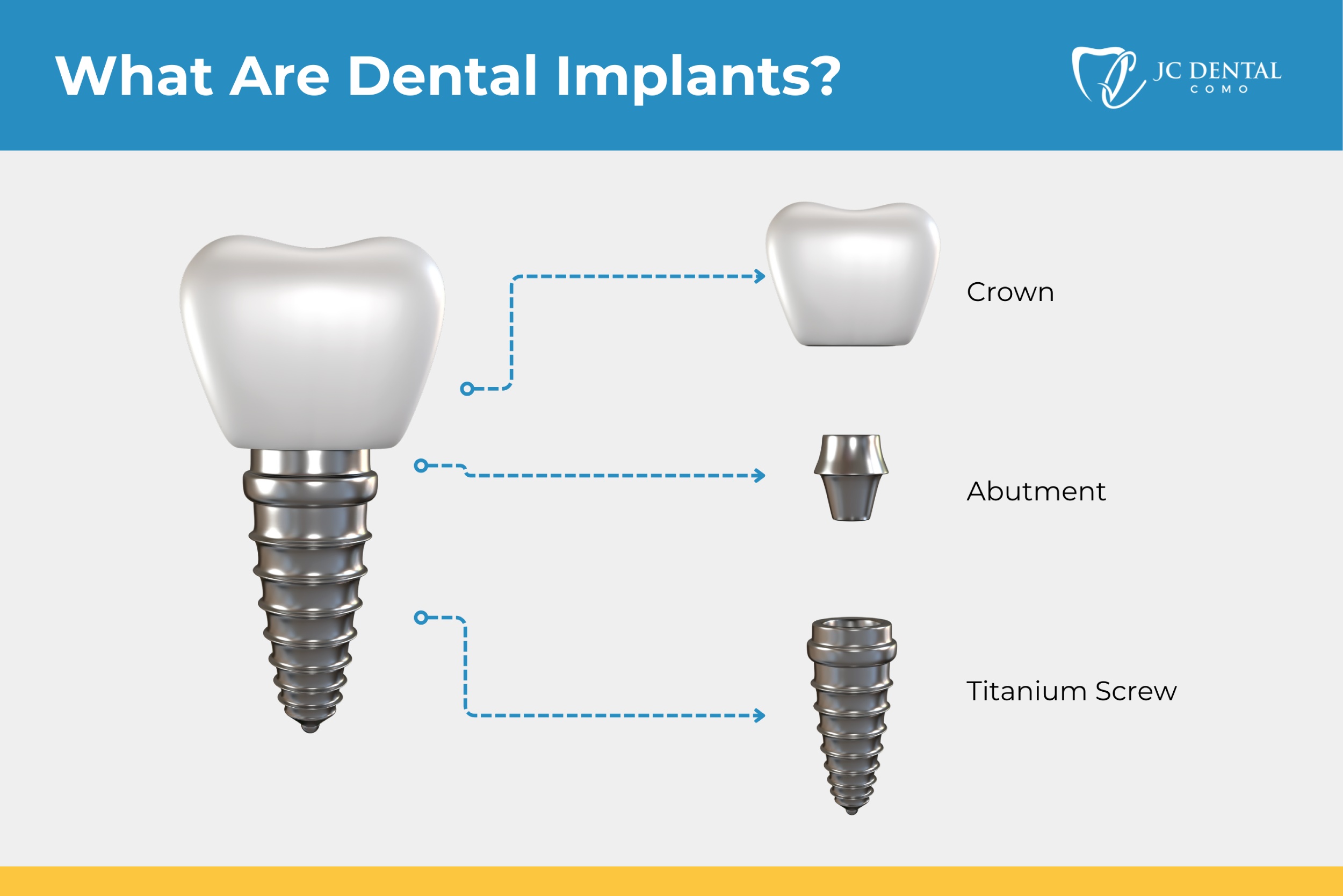 What are Dental Implants