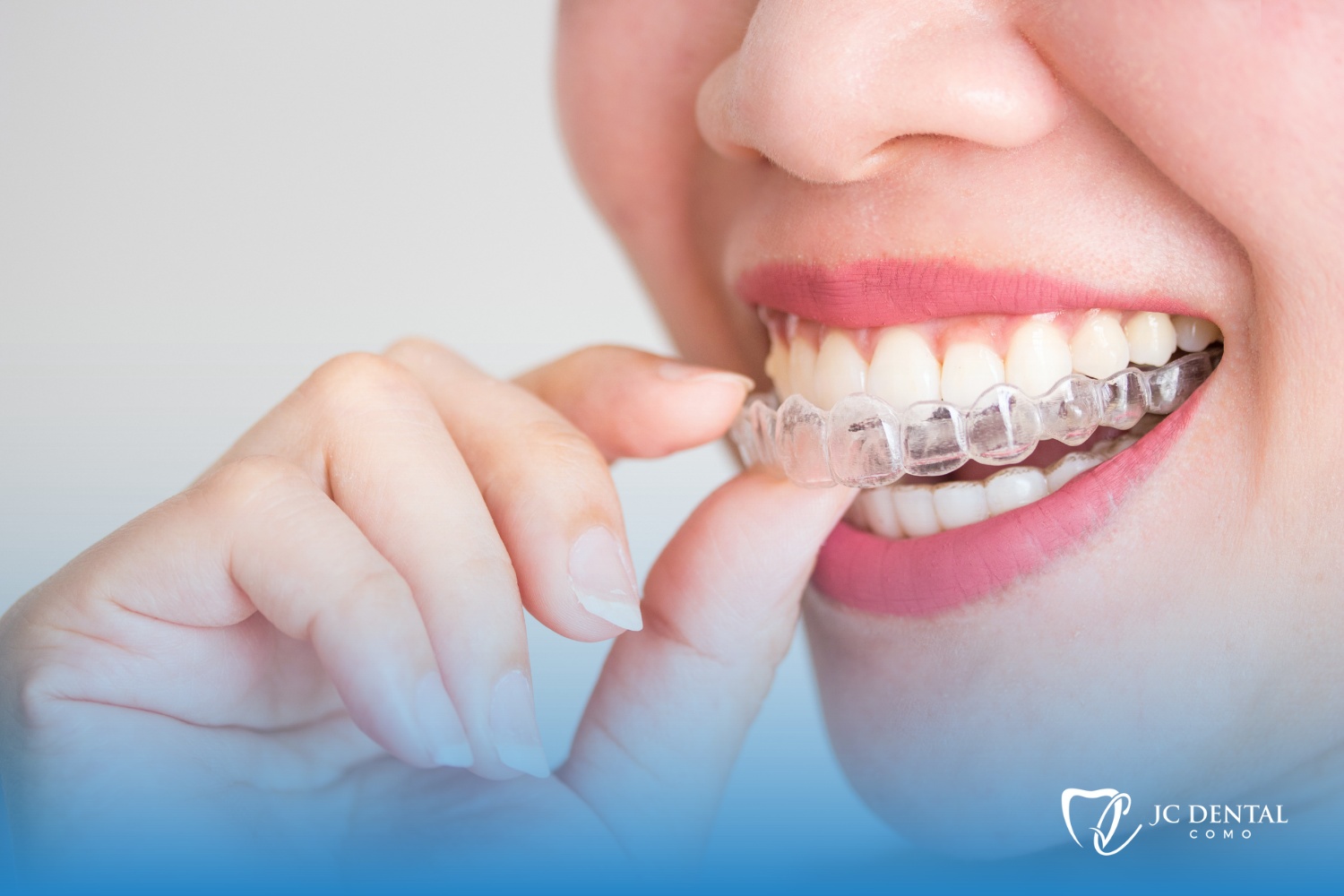 What Causes Discomfort During Invisalign Treatment
