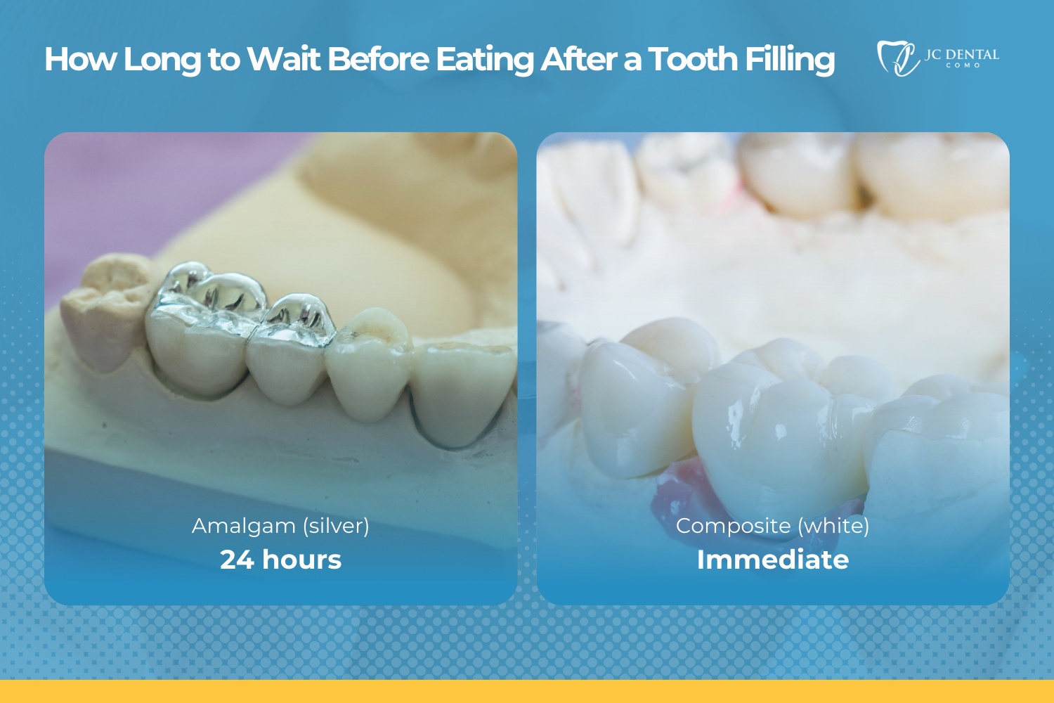 How Long After a Tooth Filling Can You Eat