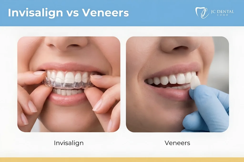 Cosmetic Dental Options: Invisalign vs Veneers - JC Dental Como