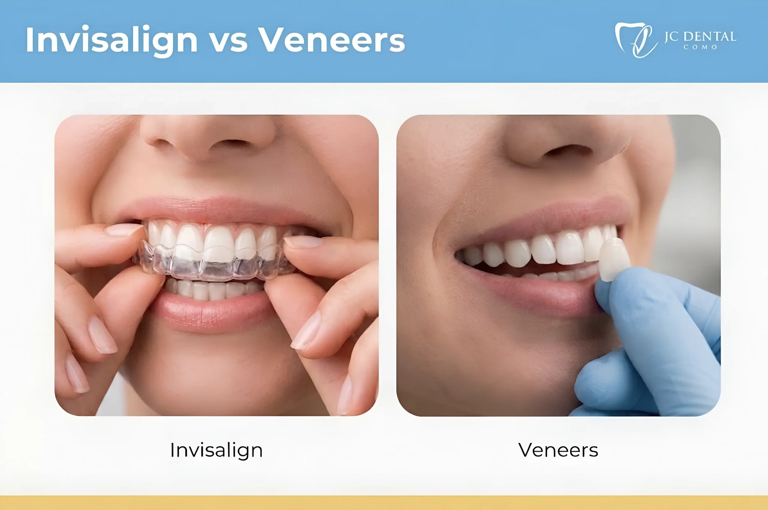 Cosmetic Dental Options: Invisalign vs Veneers - JC Dental Como