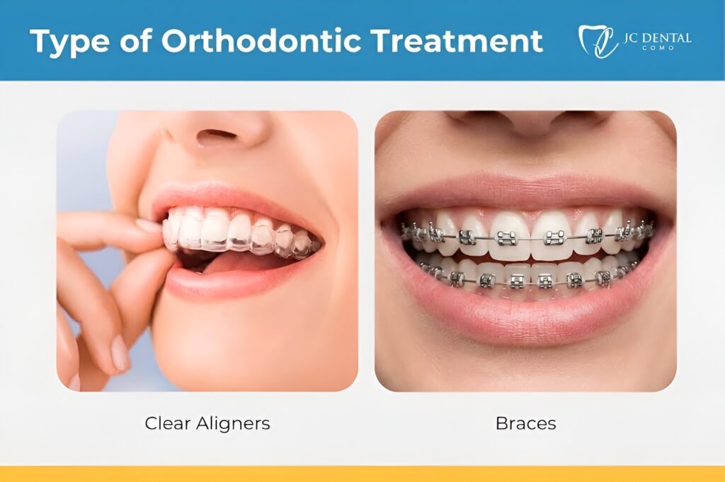 Invisalign vs Braces - JC Dental Como